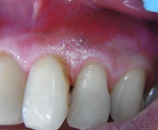 レーザー歯科治療の結果写真