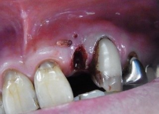 麻酔後のレーザー歯科治療の結果写真