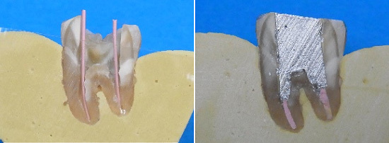 歯の根充